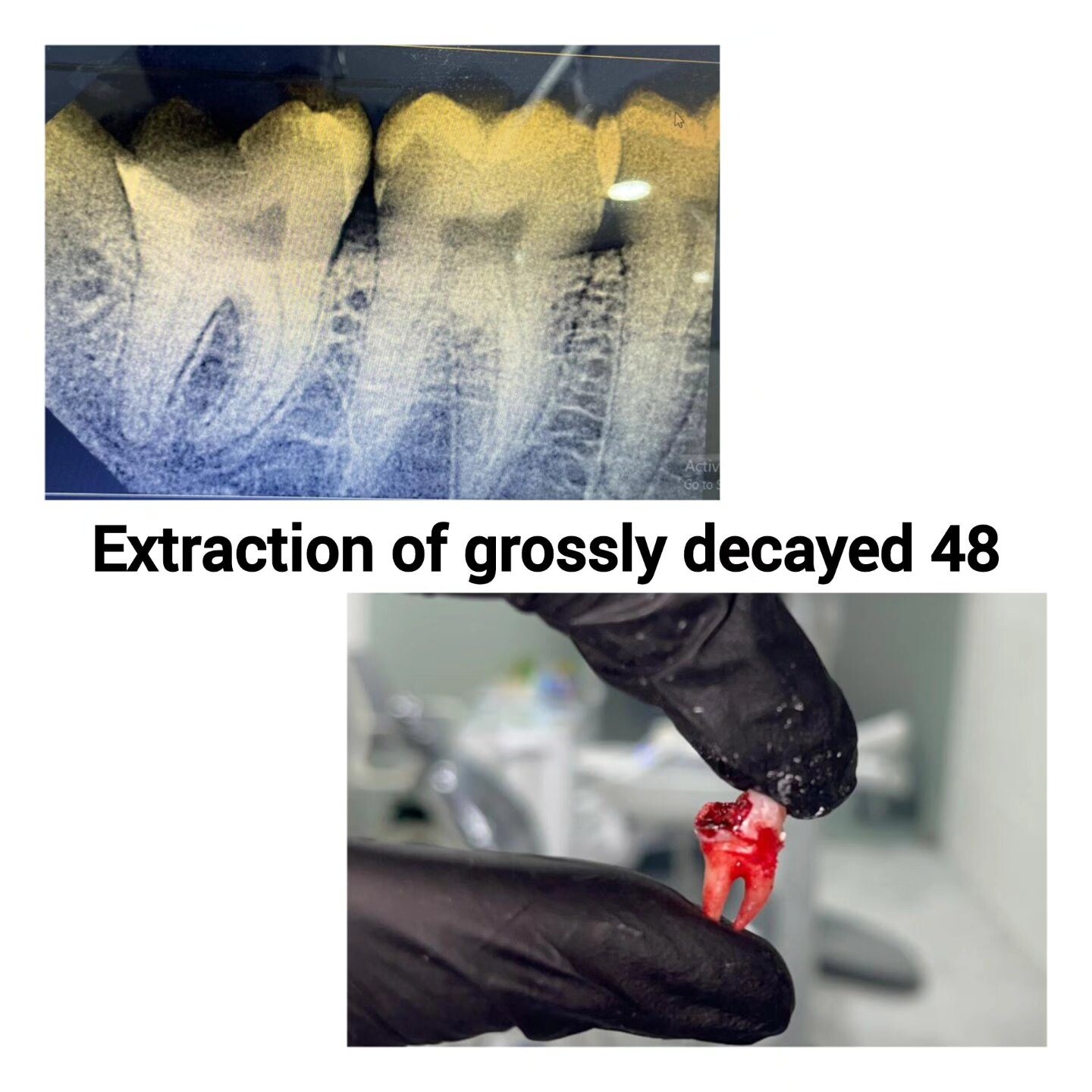 Real SmileCraft extraction case assessment