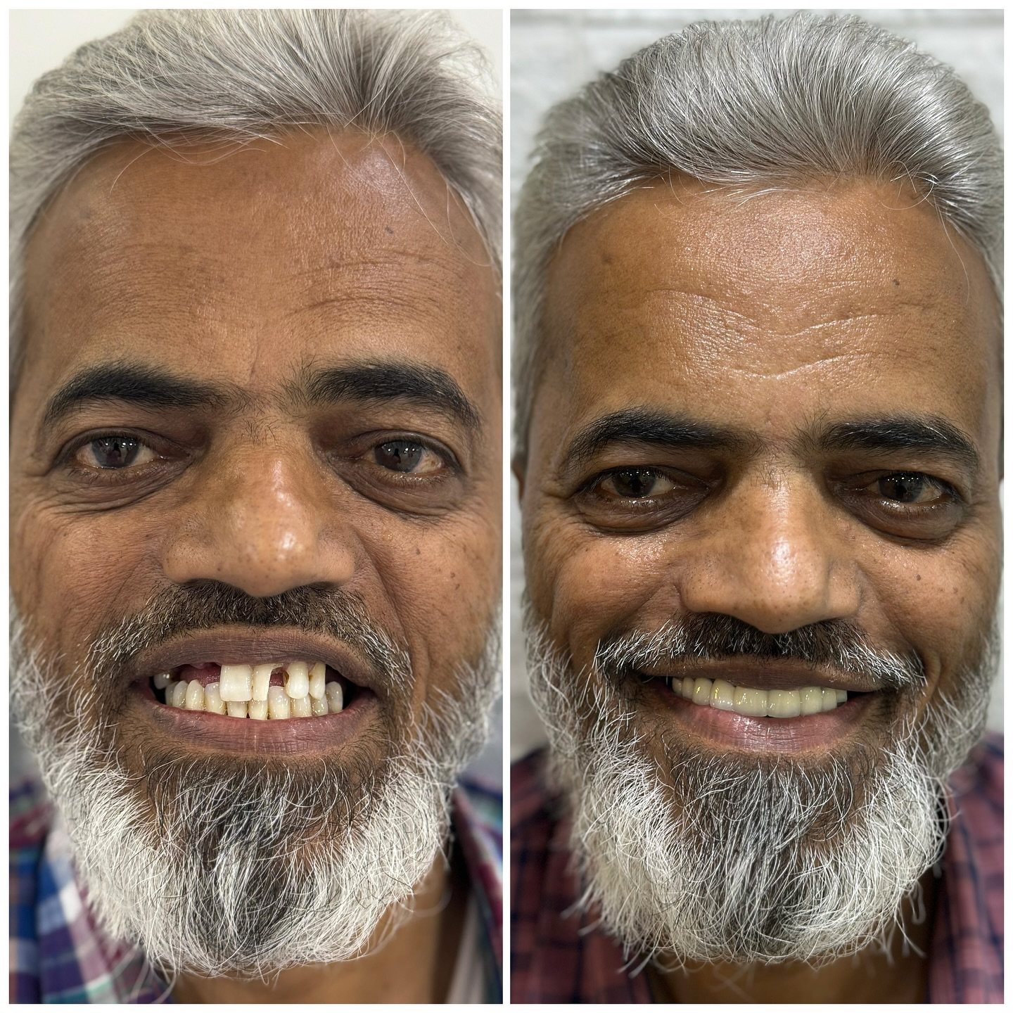 Real SmileCraft smile makeover result